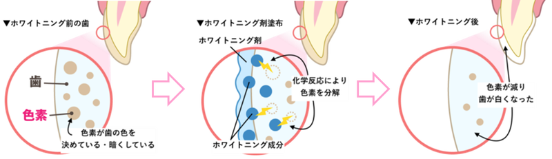 ホワイトニングのメカニズム